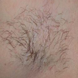 Laser Hair Removal Before & After Patient #1023