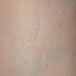 Laser Hair Removal Before & After Patient #1023
