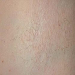 Laser Hair Removal Before & After Patient #1023