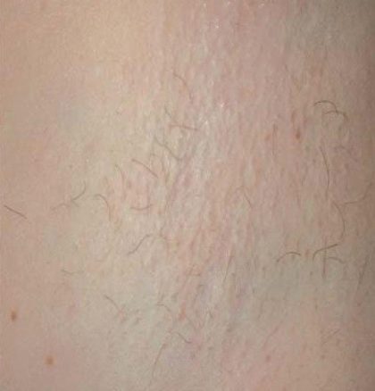 Laser Hair Removal Before & After Patient #1023