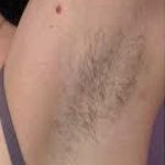 Laser Hair Removal Before & After Patient #1024