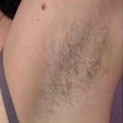 Laser Hair Removal Before & After Patient #1024