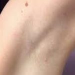 Laser Hair Removal Before & After Patient #1024