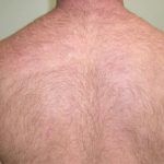Laser Hair Removal Before & After Patient #1025