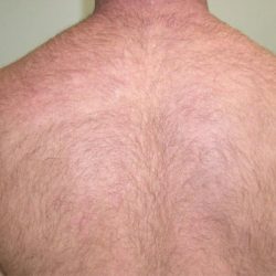 Laser Hair Removal Before & After Patient #1025