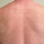 Laser Hair Removal Before & After Patient #1025