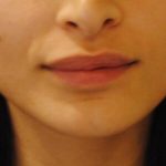 Lip Lift Before & After Patient #1625
