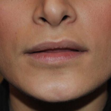 Lip Lift Before & After Patient #1625