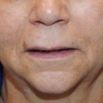 Lip Lift Before & After Patient #1626