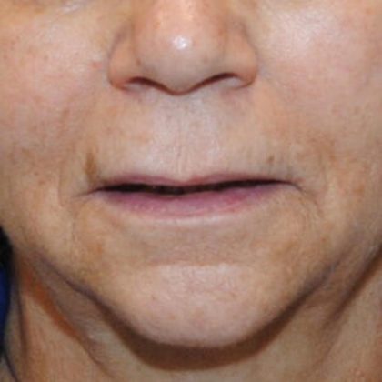 Lip Lift Before & After Patient #1626