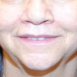 Lip Lift Before & After Patient #1626