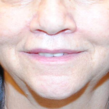 Lip Lift Before & After Patient #1626
