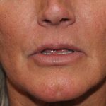 Lip Lift Before & After Patient #1627