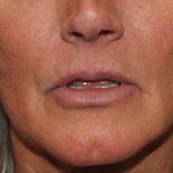 Lip Lift Before & After Patient #1627
