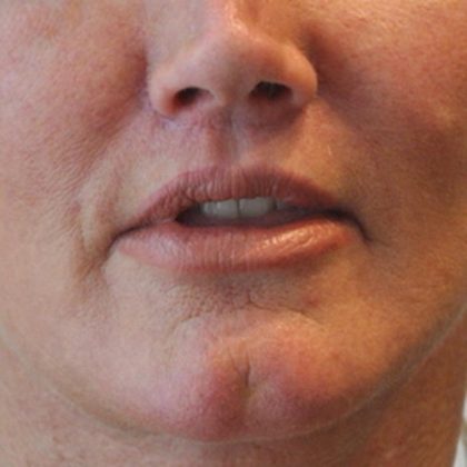 Lip Lift Before & After Patient #1627