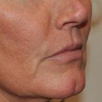 Lip Lift Before & After Patient #1627