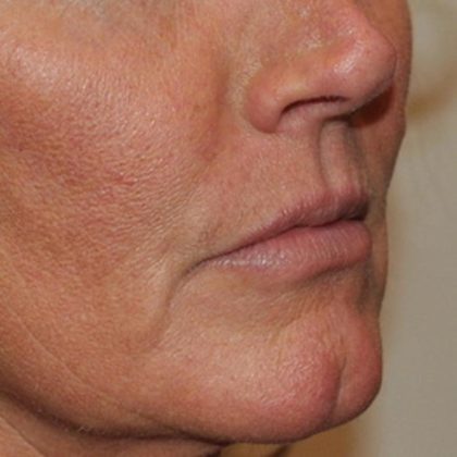 Lip Lift Before & After Patient #1627