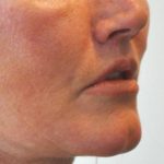 Lip Lift Before & After Patient #1627