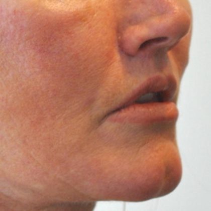 Lip Lift Before & After Patient #1627