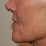 Lip Lift Before & After Patient #1627
