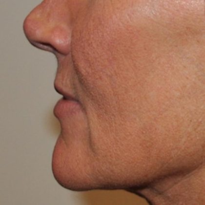 Lip Lift Before & After Patient #1627
