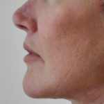 Lip Lift Before & After Patient #1627