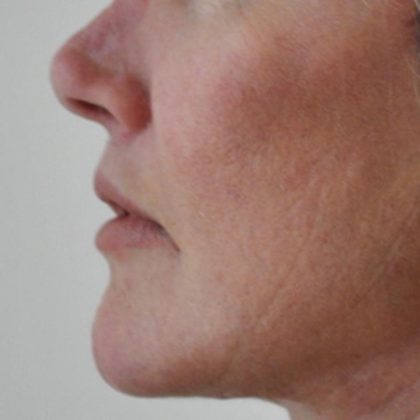 Lip Lift Before & After Patient #1627