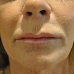 Lip Lift Before & After Patient #1628