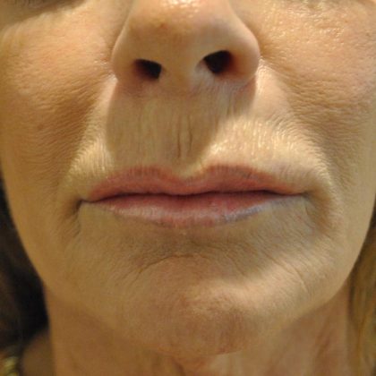 Lip Lift Before & After Patient #1628