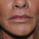 Lip Lift Before & After Patient #1628