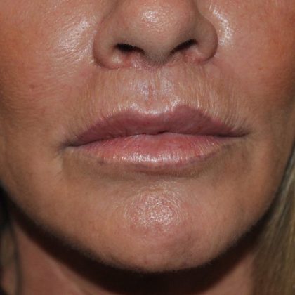 Lip Lift Before & After Patient #1628