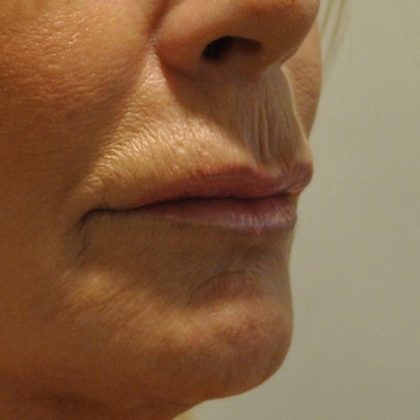 Lip Lift Before & After Patient #1628