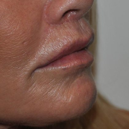Lip Lift Before & After Patient #1628