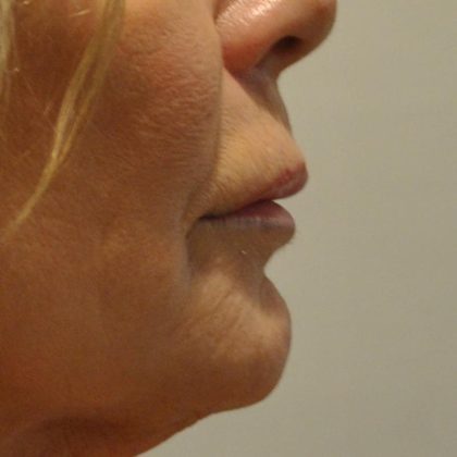Lip Lift Before & After Patient #1628