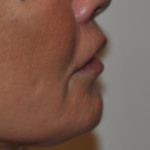 Lip Lift Before & After Patient #1628