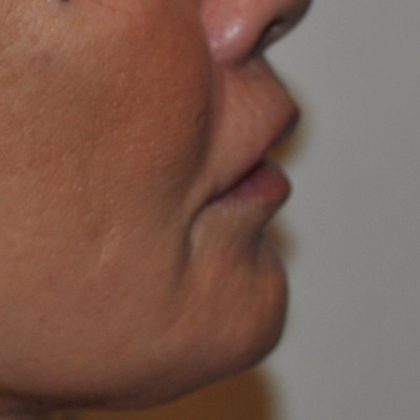 Lip Lift Before & After Patient #1628