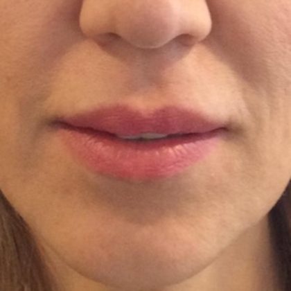 Lip Lift Before & After Patient #1629