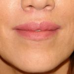 Lip Lift Before & After Patient #1629