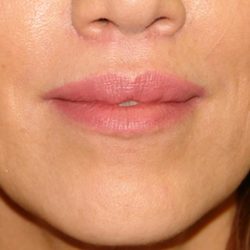 Lip Lift Before & After Patient #1629