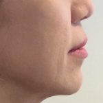 Lip Lift Before & After Patient #1629