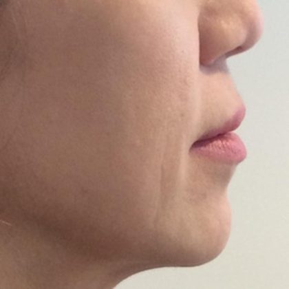 Lip Lift Before & After Patient #1629