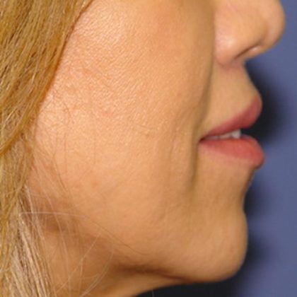 Lip Lift Before & After Patient #1629