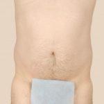 Liposuction Before & After Patient #1651