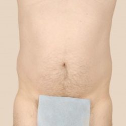 Liposuction Before & After Patient #1651