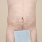 Liposuction Before & After Patient #1651