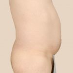 Liposuction Before & After Patient #1651