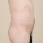 Liposuction Before & After Patient #1651