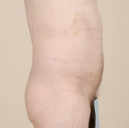 Liposuction Before & After Patient #1651