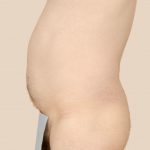 Liposuction Before & After Patient #1651