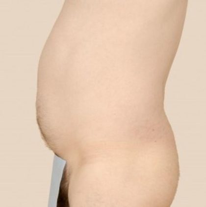 Liposuction Before & After Patient #1651